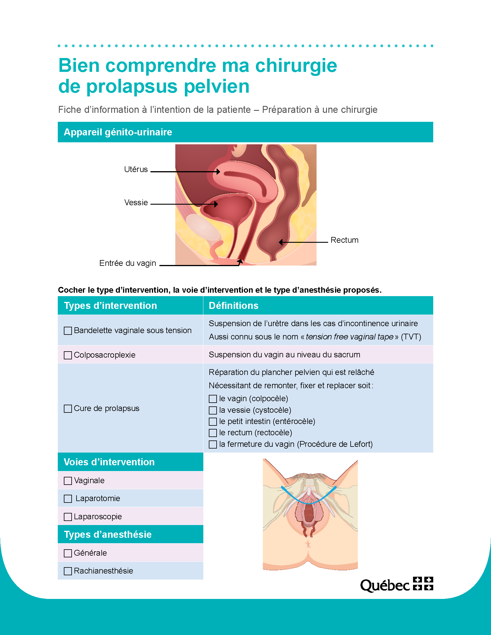 bien-comprendre-ma-chirurgie-prolapsus-pelvien--cpsfe137(2018)